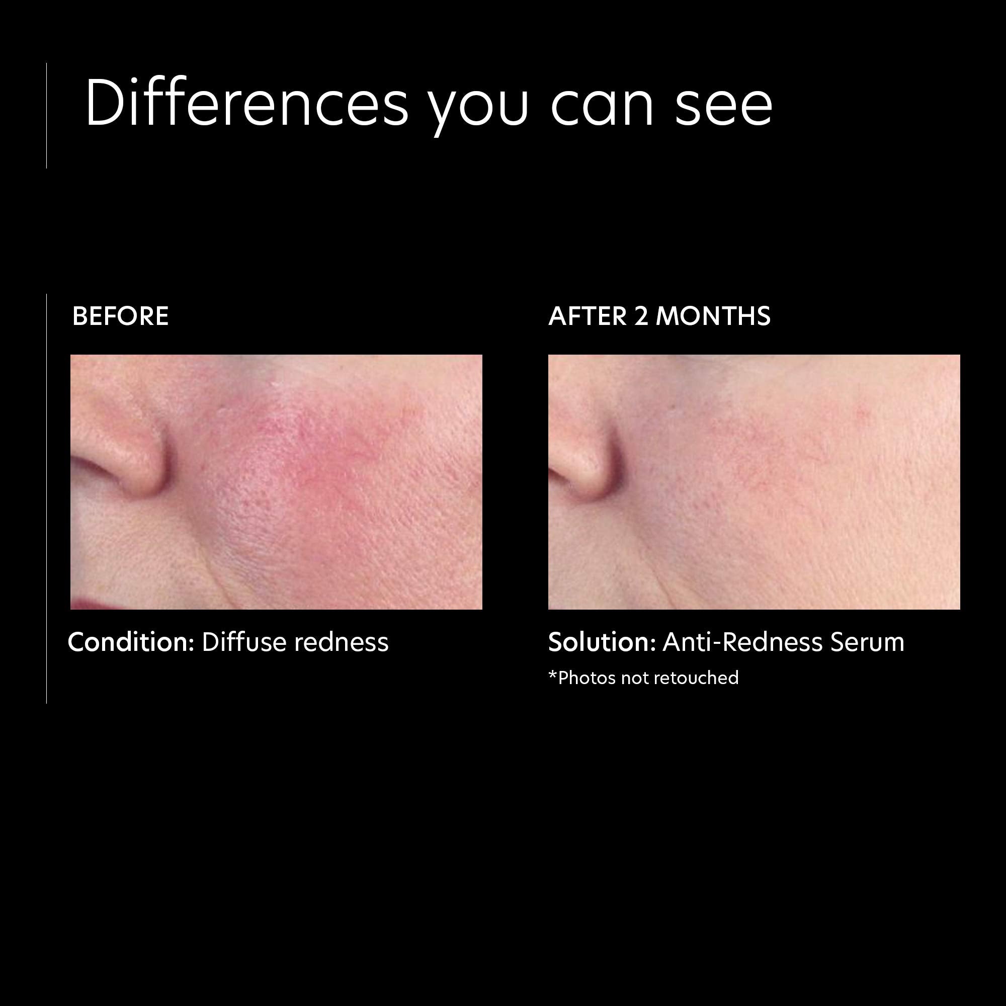 PCA SKIN application area highlight on persistent redness