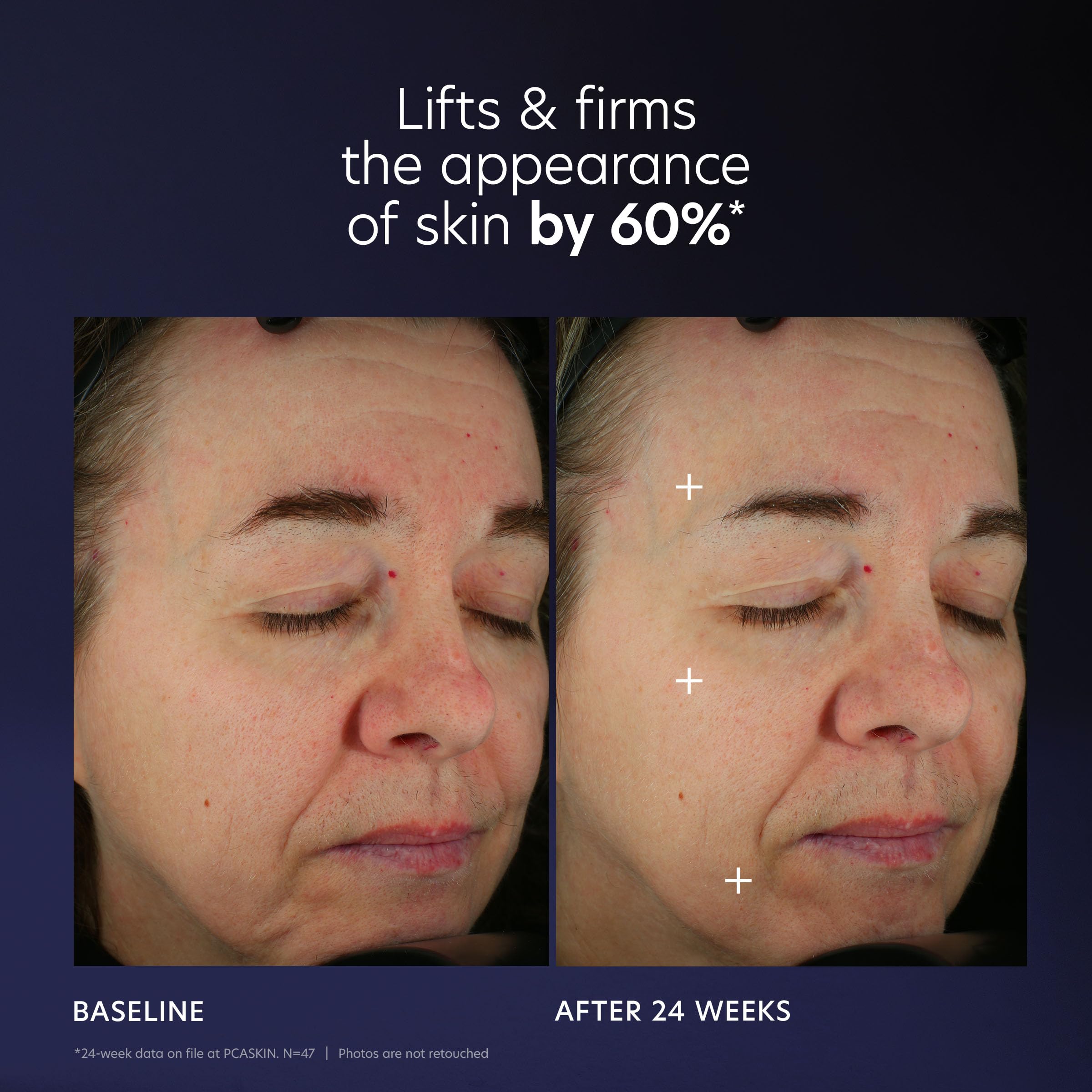 PCA SKIN Pro Max Age Renewal neck and face closeup suggesting smoother texture.