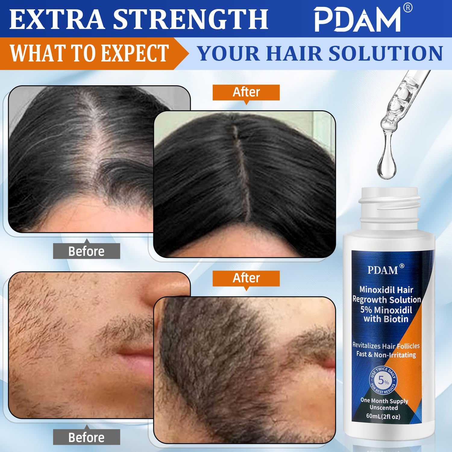 Pdam Minoxidil scalp application on thinning areas
