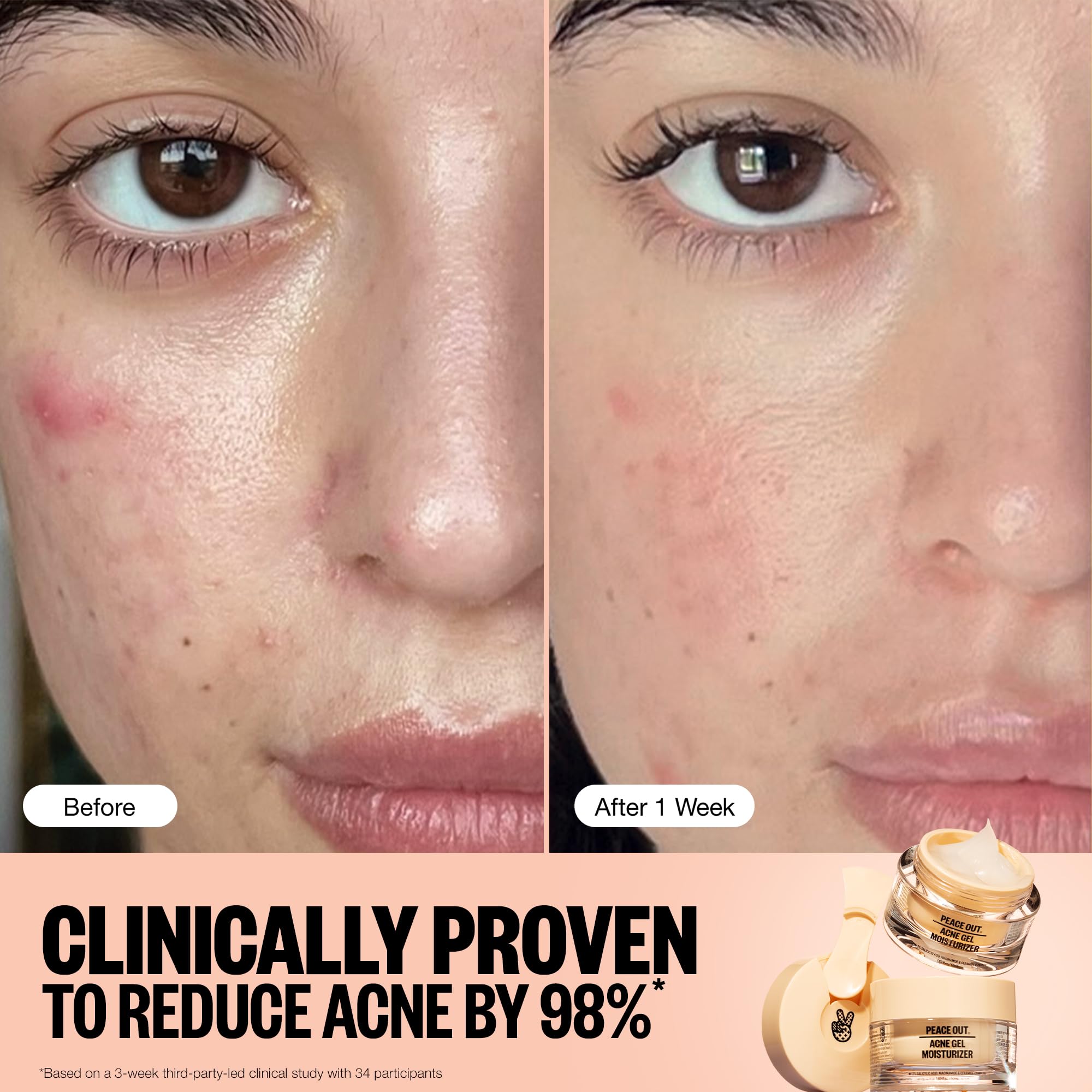 PEACE OUT Acne Gel Moisturizer on-face application showing fast absorption and non-greasy feel