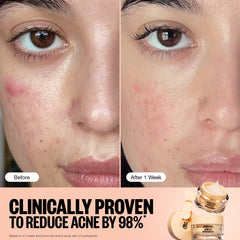 PEACE OUT Acne Gel Moisturizer on-face application showing fast absorption and non-greasy feel
