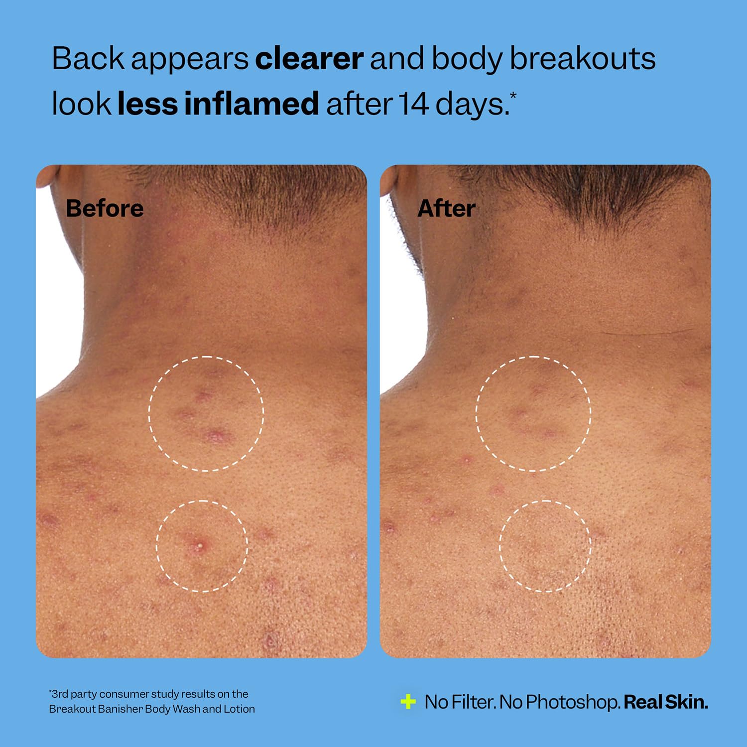 Peach Slices Breakout Banisher glycolic acid exfoliates for smoother skin