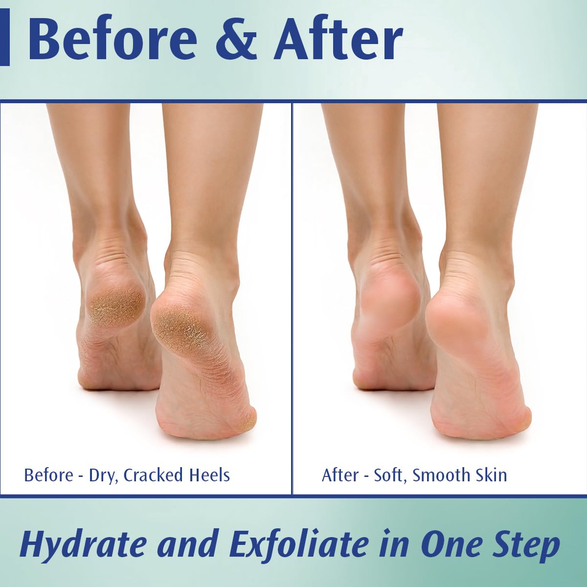 Pedifix 20 percent urea foot smoothing cream jar revitalizes rough skin.