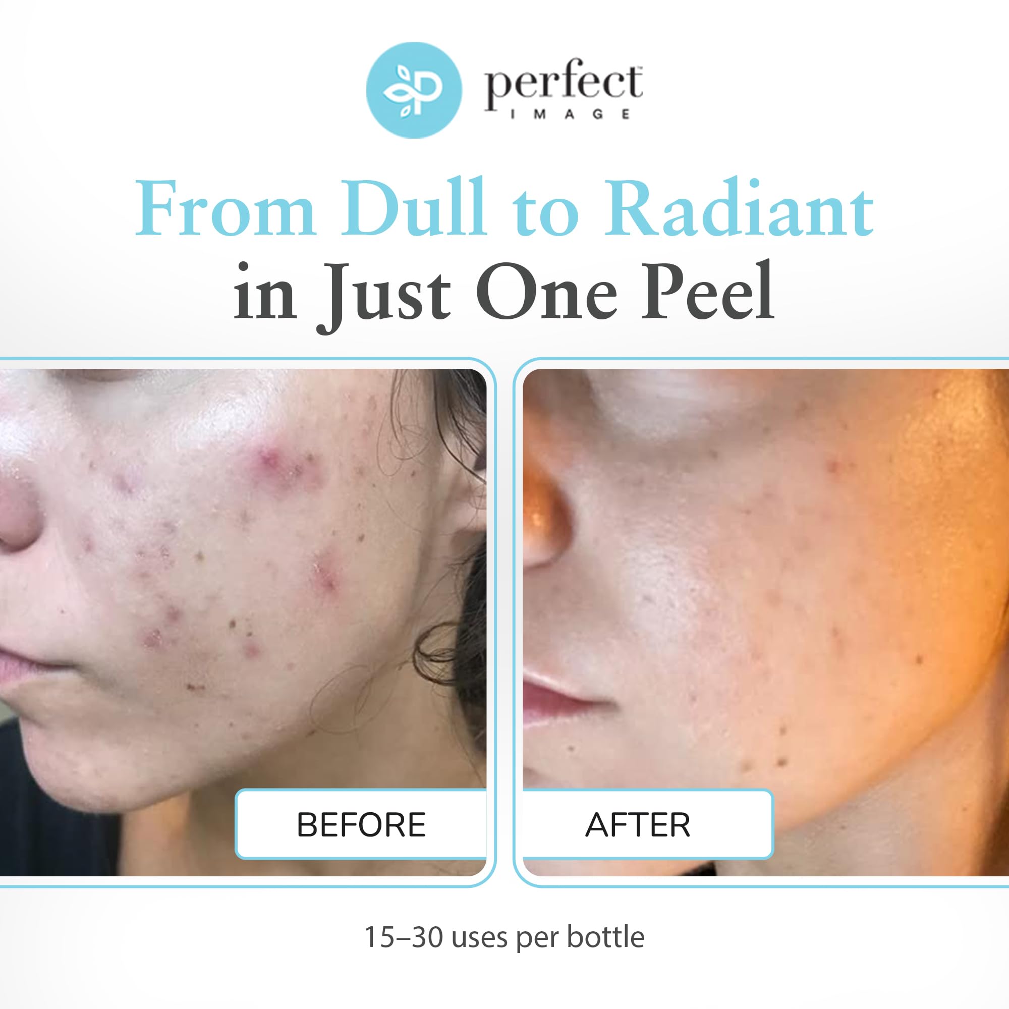 Perfect Image Glycolic 30% Peel gel texture shown for smooth exfoliation.
