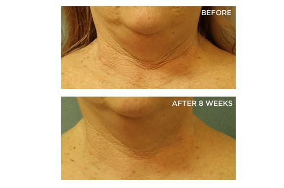 Perricone MD peptide blend supporting neck skin firmness