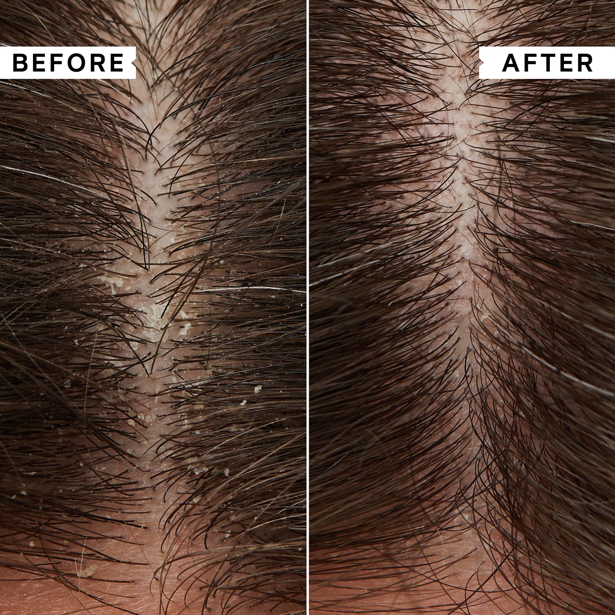 Philip Kingsley Flaky Scalp Shampoo scalp closeup demonstrates soothing action.