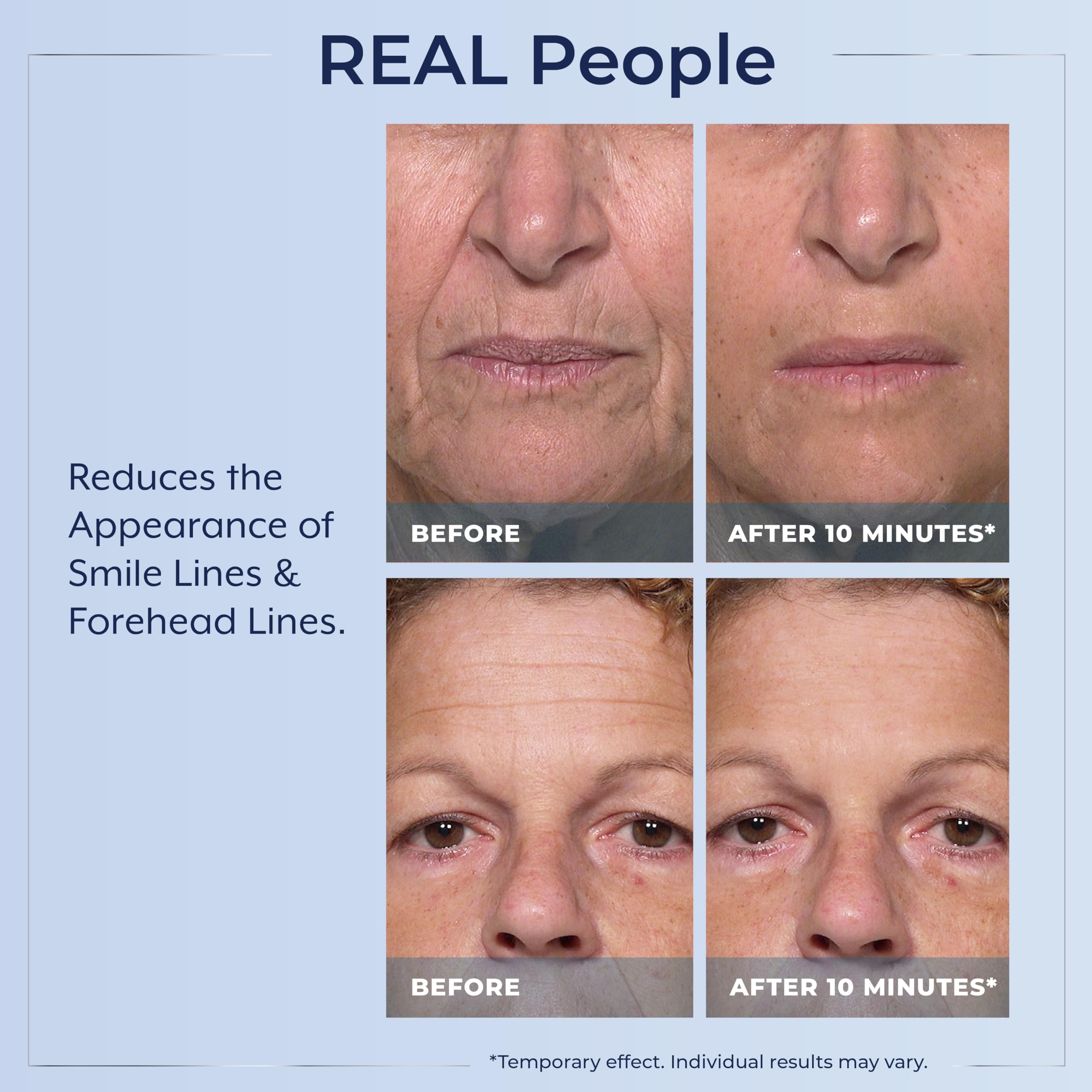 Plexaderm Rapid Reduction Eye Serum visible reduction of under-eye puffiness after use.