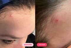 Plumpie Hydro Patch salicylic acid unclogs pores