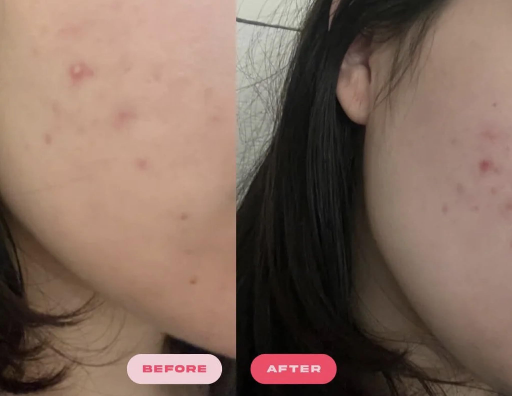 Plumpie Hydro Patch zinc anti-redness soothing swollen skin