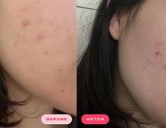 Plumpie Hydro Patch zinc anti-redness soothing swollen skin