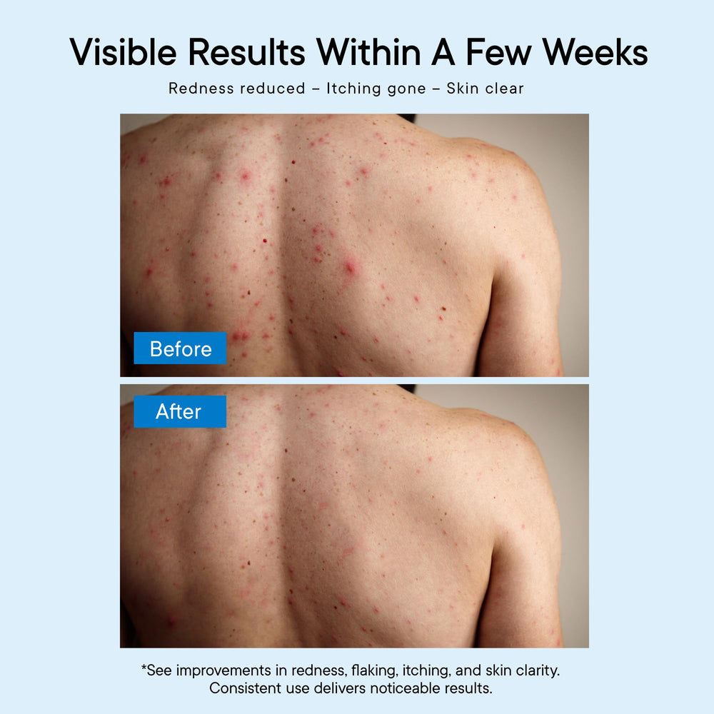 ProBliva Antifungal Body Wash Tolnaftate 1% supports targeted fungal care.