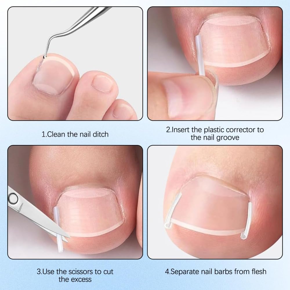 Professional Pedicure Tools curved patches align nails for gradual correction.