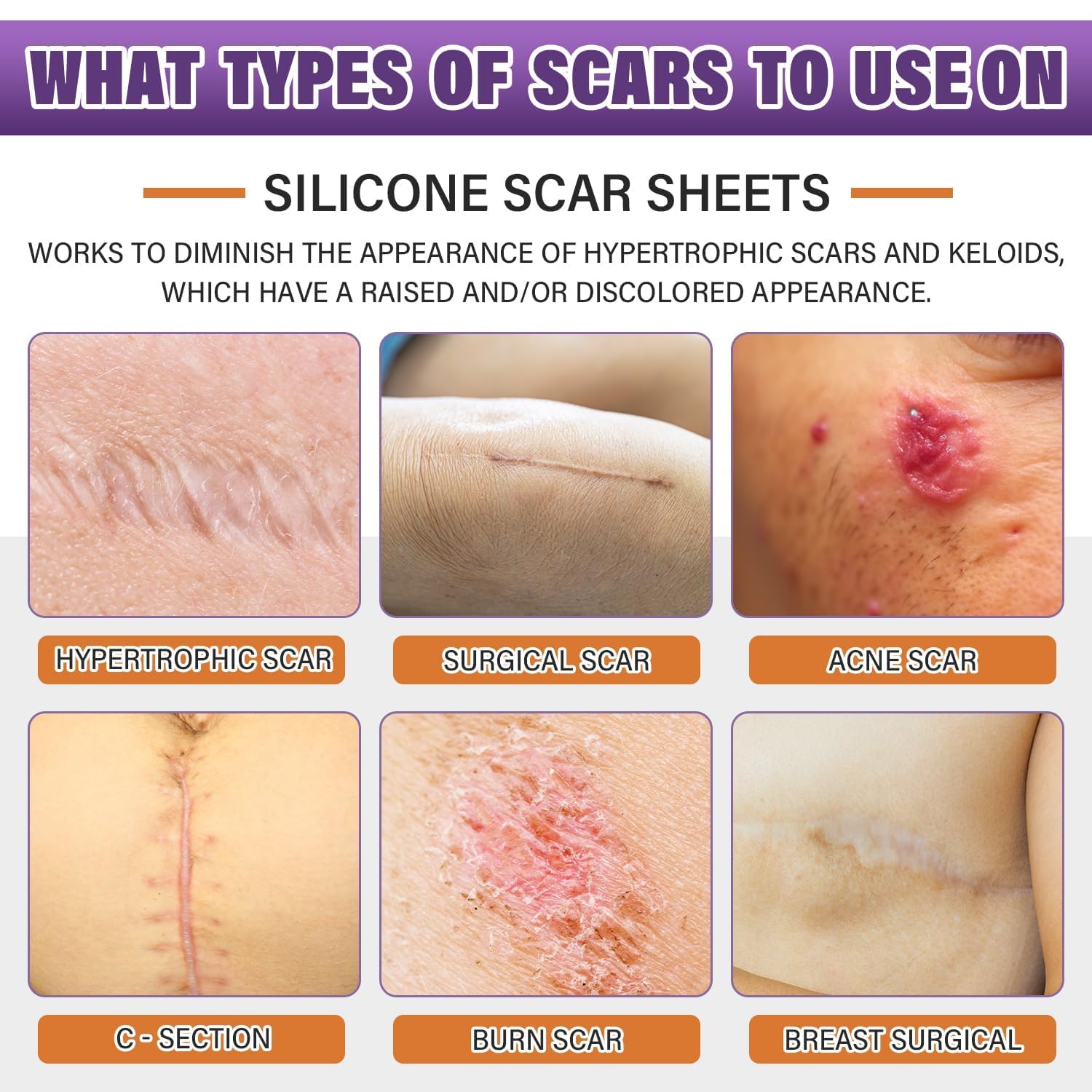 Psecici silicone scar sheets cut to fit a scar size for precise coverage