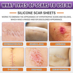 Psecici silicone scar sheets cut to fit a scar size for precise coverage