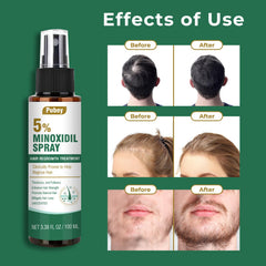 Pugbey minoxidil spray application on scalp for targeted thinning area use.