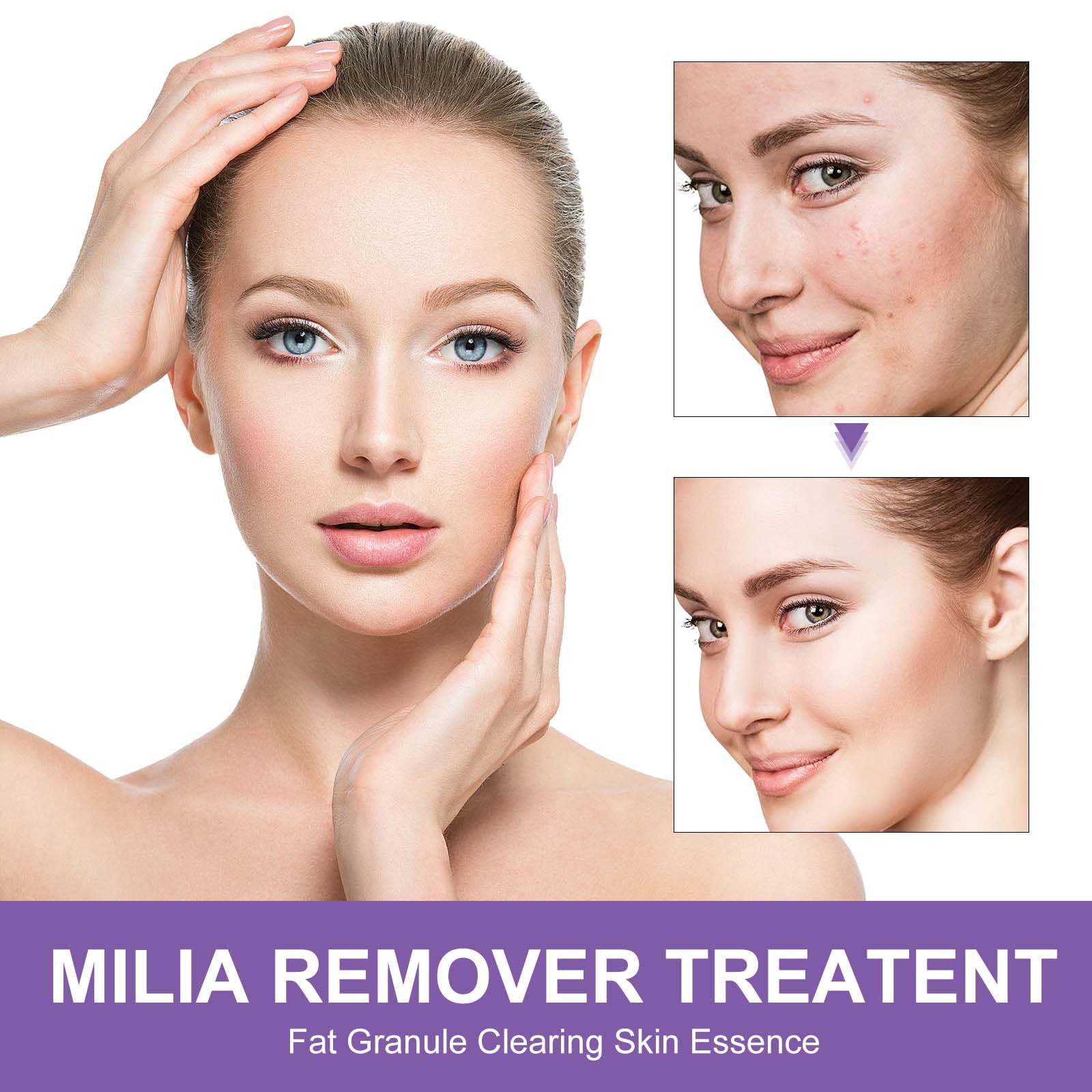 QKDBLWX milia spot treatment bottle targets small milia with salicylic acid.