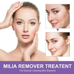 QKDBLWX milia spot treatment bottle targets small milia with salicylic acid.