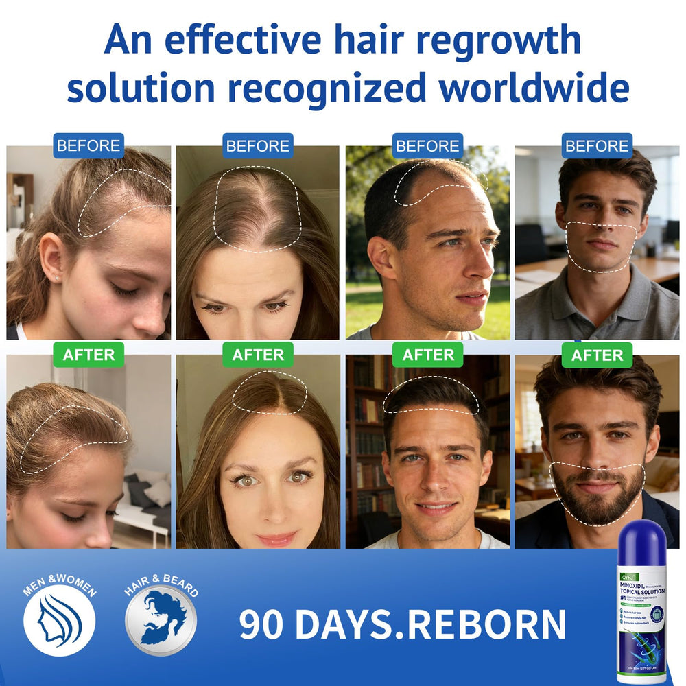 QYFJ Minoxidil bottle with sponge applicator for precise, drip-free application.
