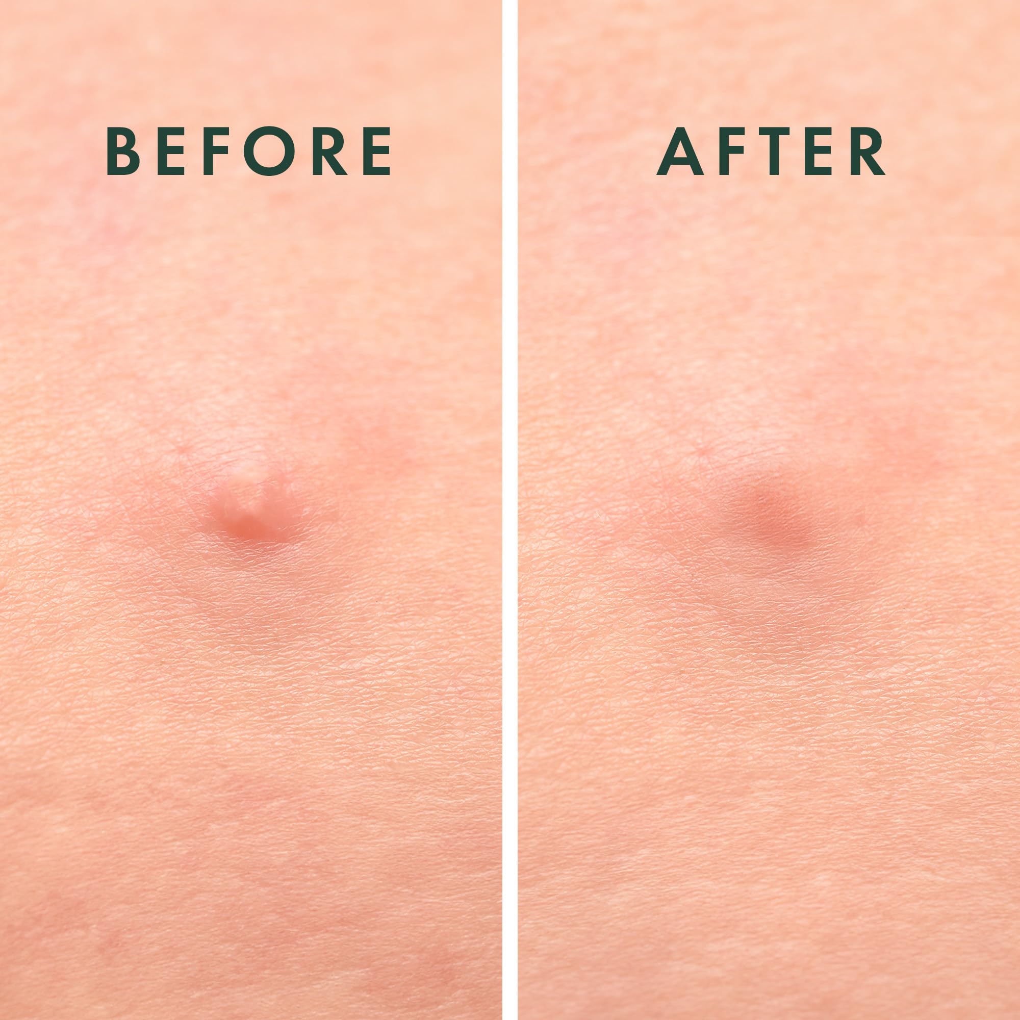 Rael patches applied on the face protect blemishes from irritants during daily activities.