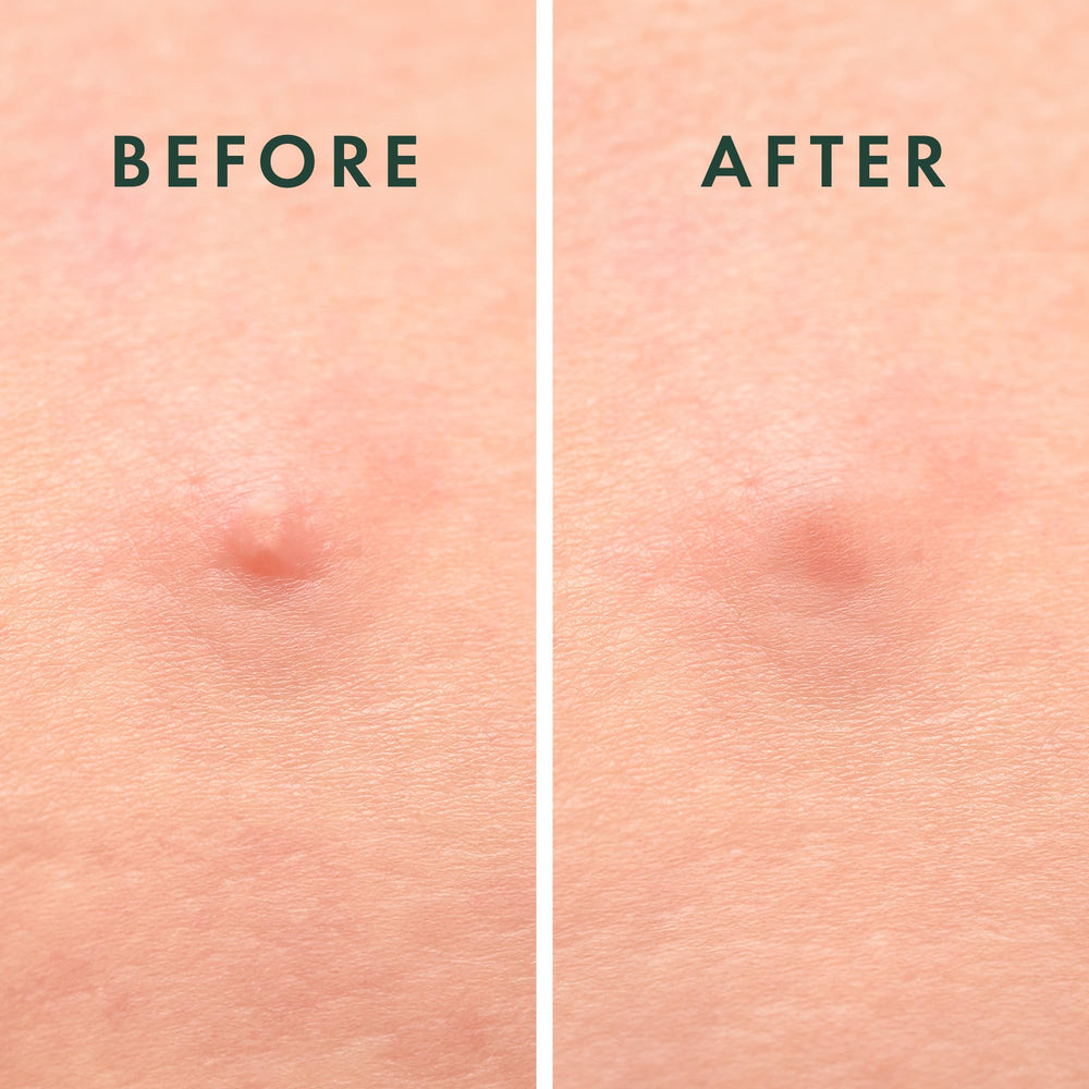Rael patches applied on the face protect blemishes from irritants during daily activities.