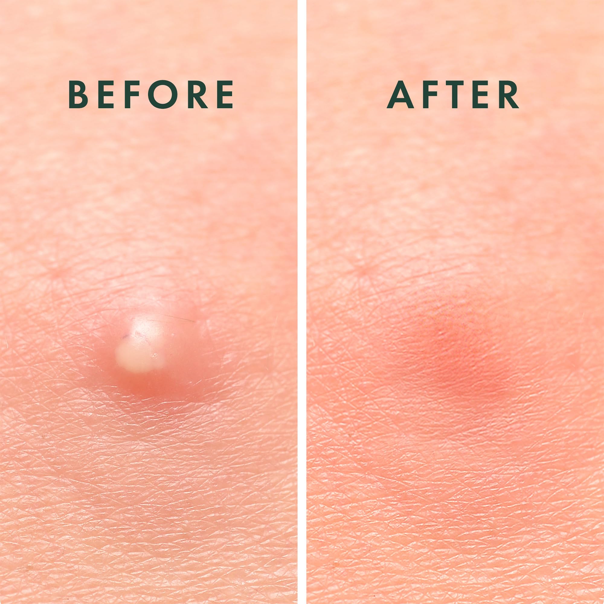 Rael hydrocolloid patches stay on skin during daily activities and sleep.