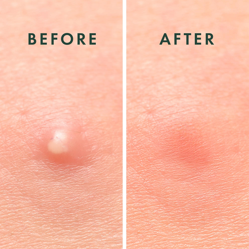 Rael hydrocolloid patches stay on skin during daily activities and sleep.
