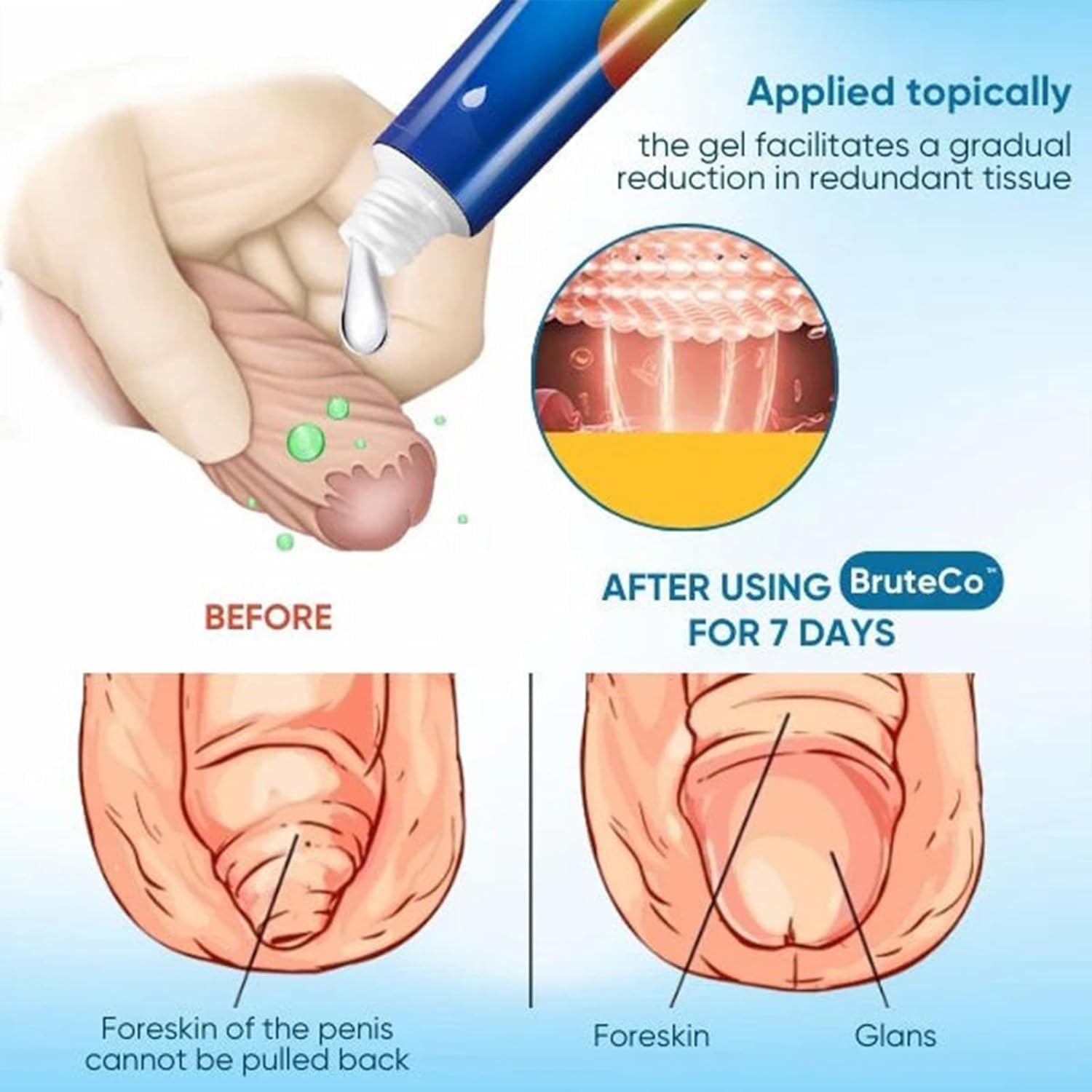 RCSCBC gel dispensing action demonstrating easy application and control