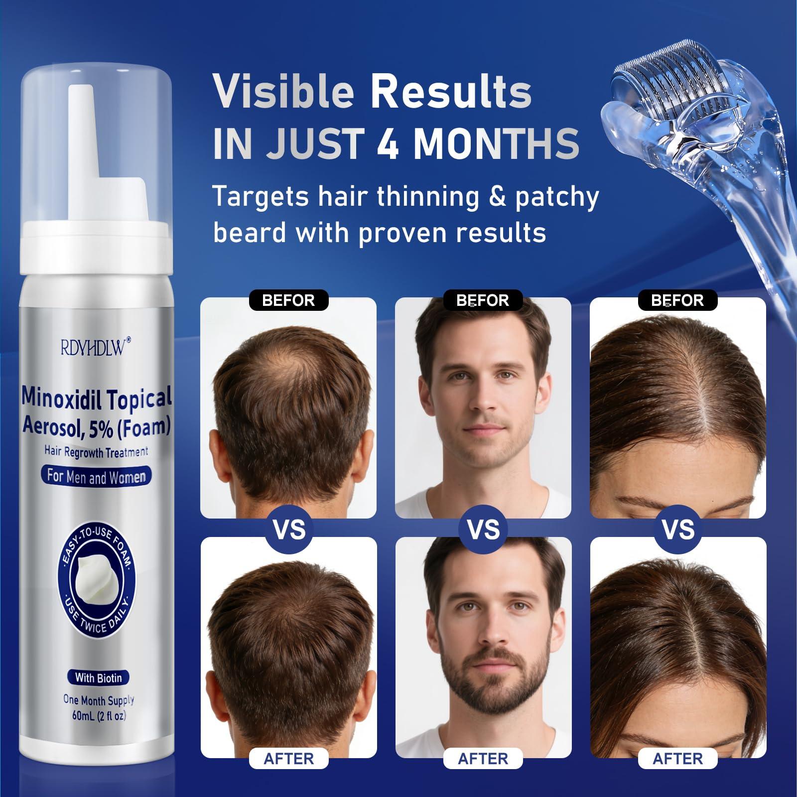 RDVHDLW minoxidil foam dries quickly with a non-greasy feel.