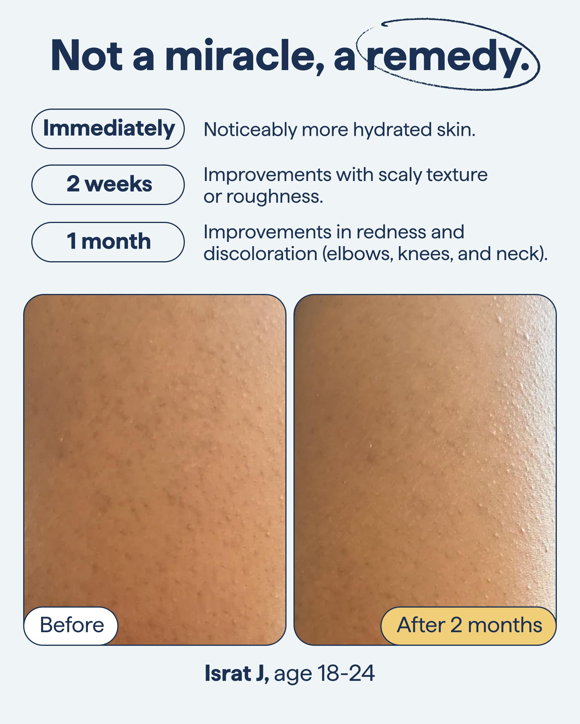Creamy Remedy Science KP Exfoliating Body Moisturizer bottle easing dryness