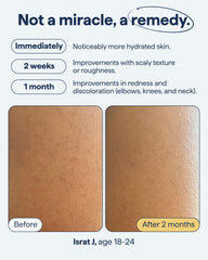 Creamy Remedy Science KP Exfoliating Body Moisturizer bottle easing dryness