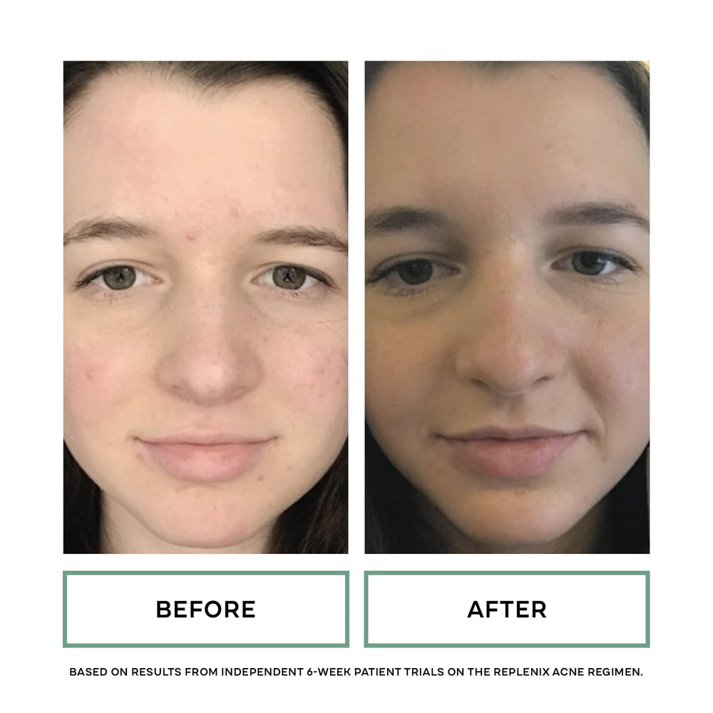 Replenix Gly-Sal texture improvement closeup after cleanse
