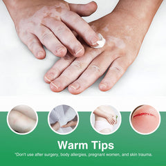Richie House Vitiligo Cream daily-use routine illustrated