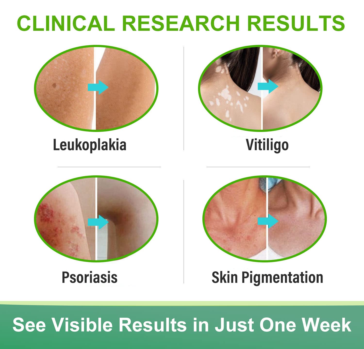Richie House Vitiligo Cream promotes an even-tone look