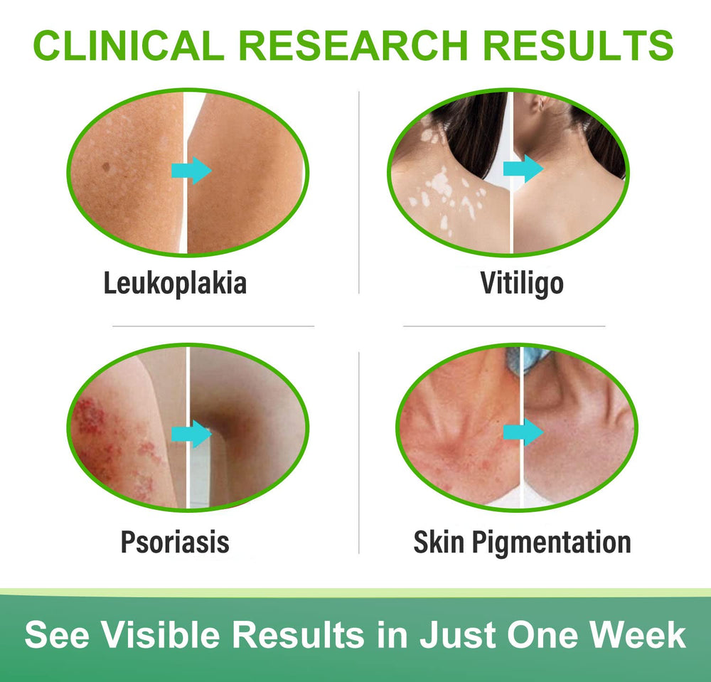 Richie House Vitiligo Cream promotes an even-tone look