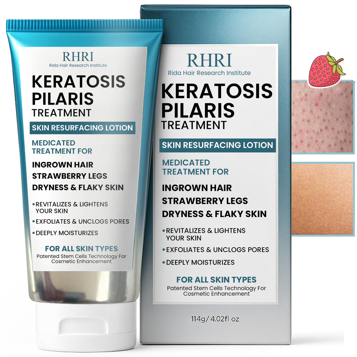 Rida Keratosis Pilaris Treatment bottle shows a hydrating formula for smoother skin.