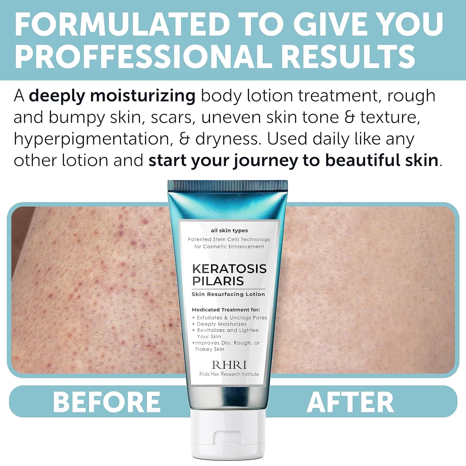 Rida Keratosis Pilaris Treatment glycolic acid aids gentle exfoliation.