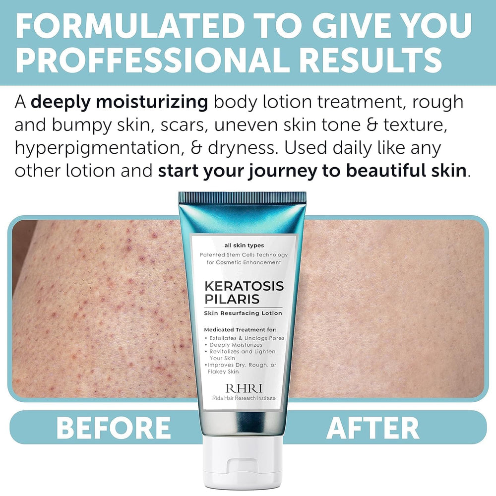 Rida Keratosis Pilaris Treatment glycolic acid aids gentle exfoliation.