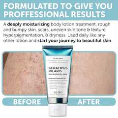 Rida Keratosis Pilaris Treatment glycolic acid aids gentle exfoliation.