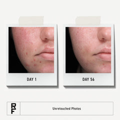 Rodan + Fields Spotless Daily Acne Wash foam close-up for deep pore cleansing.