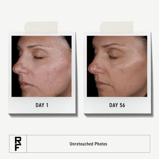 Rodan + Fields Unblemish clarifying toner being applied to balance tone.