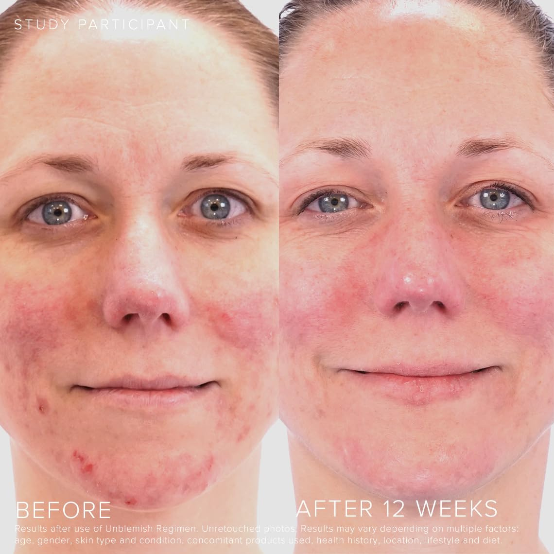 Rodan + Fields Unblemish includes benzoyl peroxide and ceramides for skin comfort.