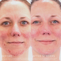 Rodan + Fields Unblemish includes benzoyl peroxide and ceramides for skin comfort.