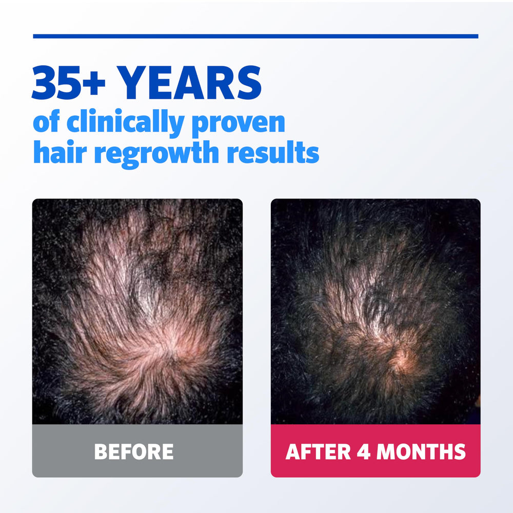 Rogaine scalp application technique demonstrated on the crown.