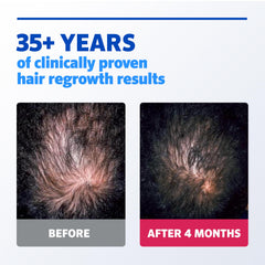 Rogaine scalp application technique demonstrated on the crown.