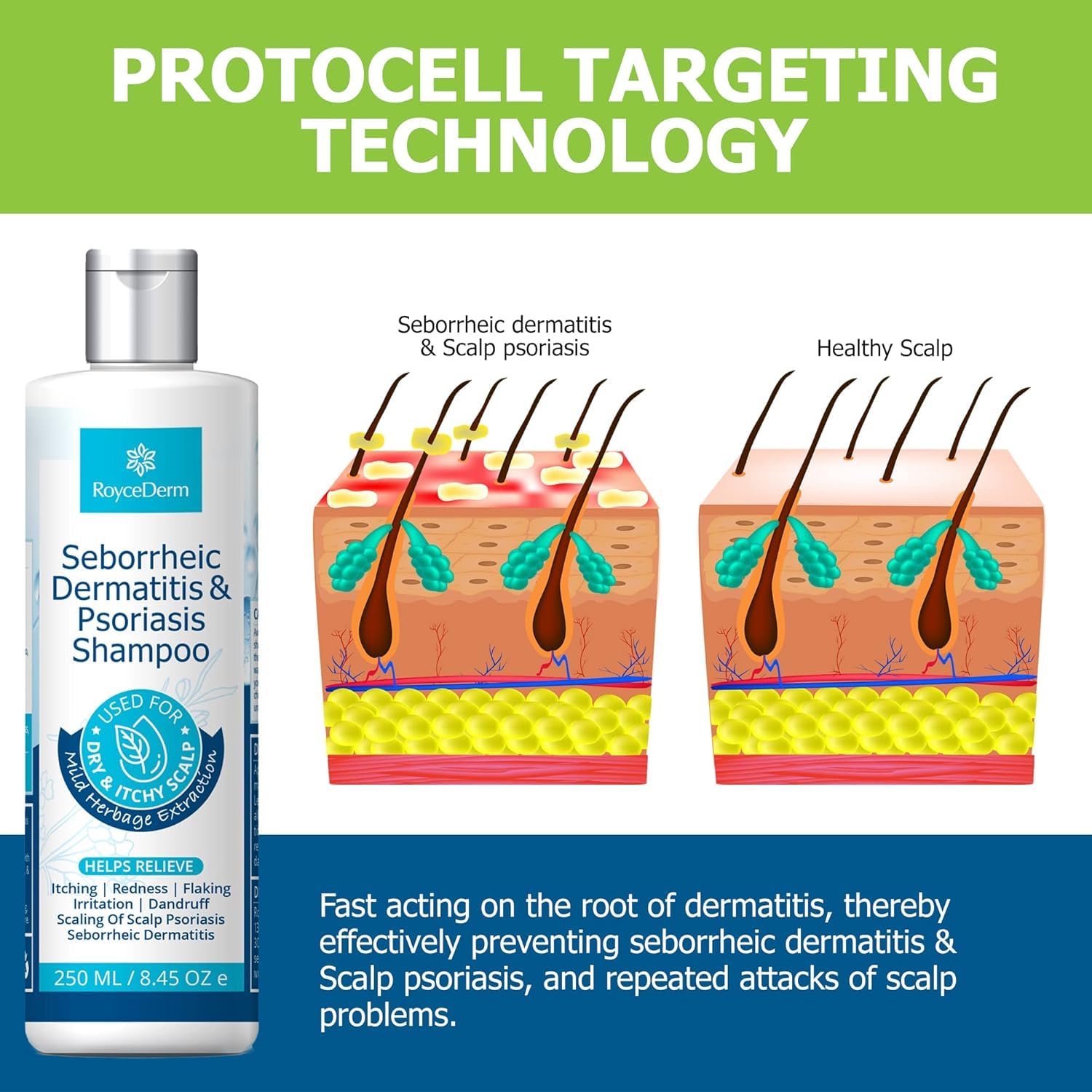 Roycederm Psoriasis Shampoo foamy lather promotes easy scalp treatment.