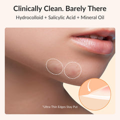 RPE Life Korean Pimple Patches large 46x30-5mm patch on hotspot