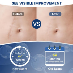 Targeted application area with Rvlaim scar care gel on skin
