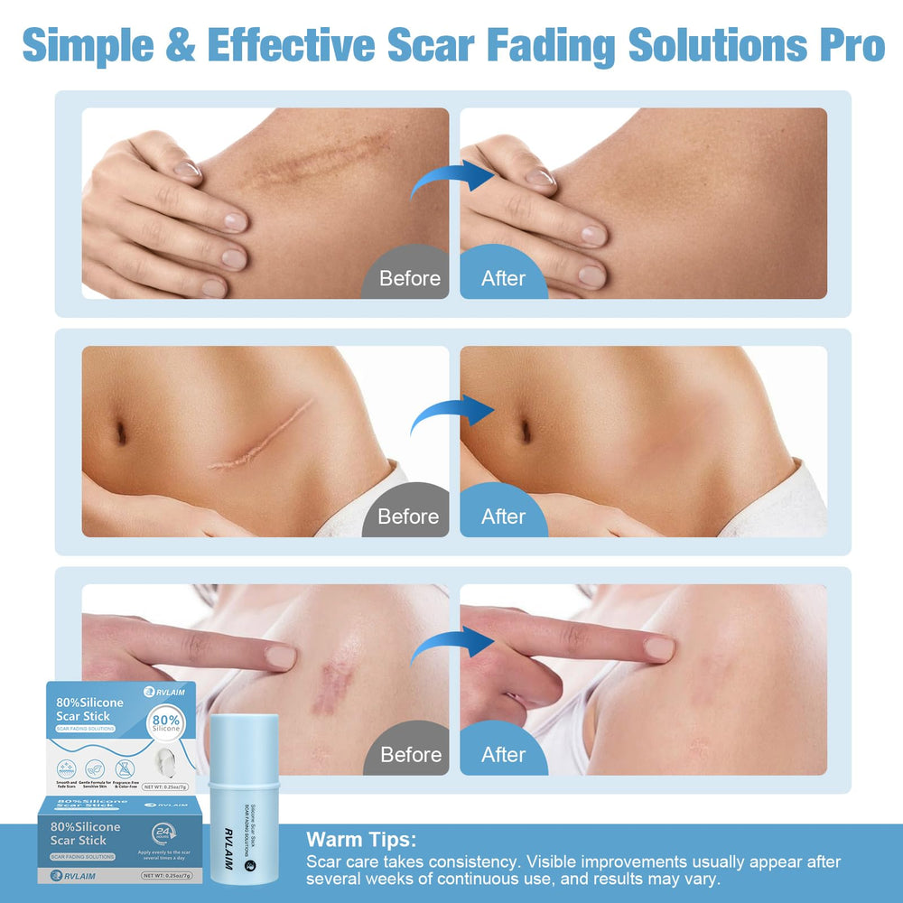 Rvlaim scar stick with onion extract improving scar appearance