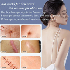 Safirst keloid scar tape for multiple scar types, easy to cut.