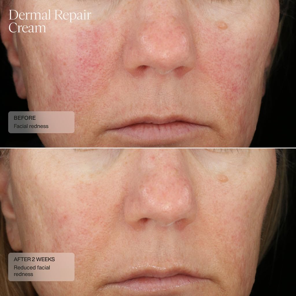 Sente Dermal Repair Cream applied to face demonstrates quick absorption and comfortable finish